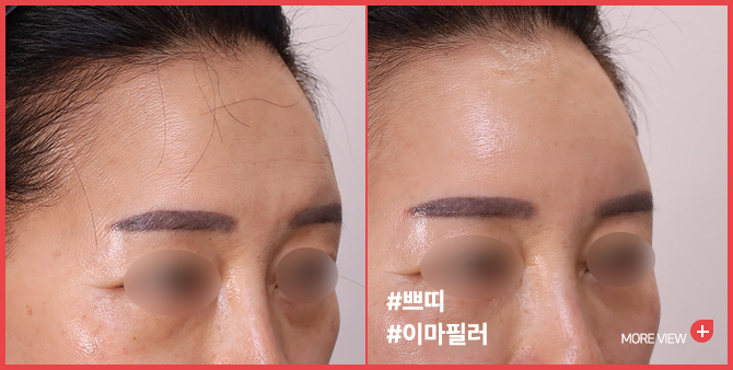 엣지 성형외과&피부과 이마필러 BEFORE / AFTER