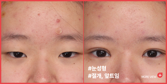 엣지 성형외과&피부과 눈성형 BEFORE / AFTER