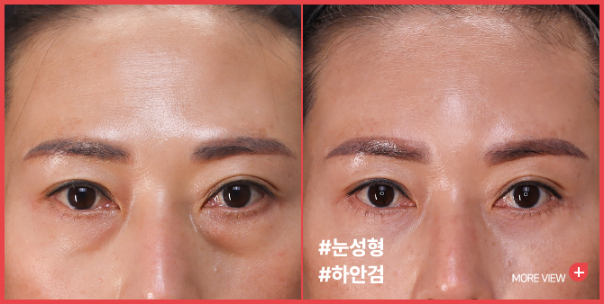엣지 성형외과&피부과 눈밑지방재배치 BEFORE / AFTER