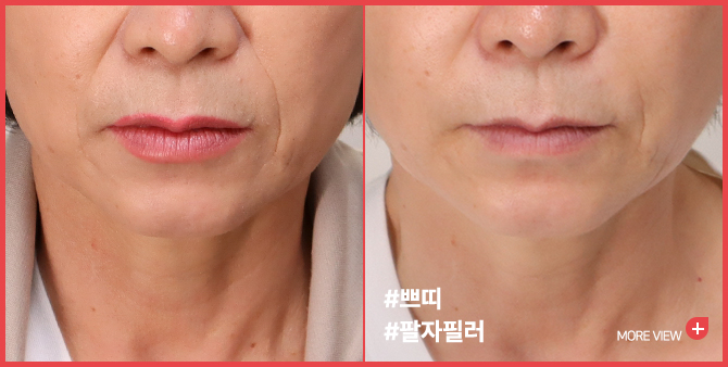엣지 성형외과&피부과 팔자주름 필러 BEFORE / AFTER