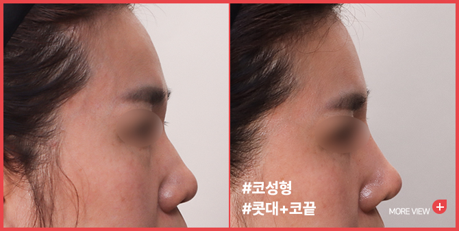 엣지 성형외과&피부과 코 성형 BEFORE / AFTER