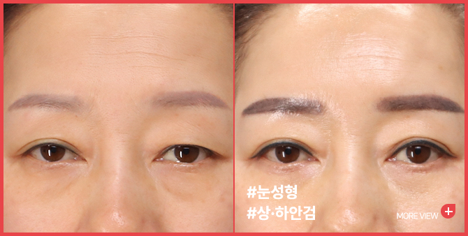 엣지 성형외과&피부과 눈 성형 BEFORE / AFTER