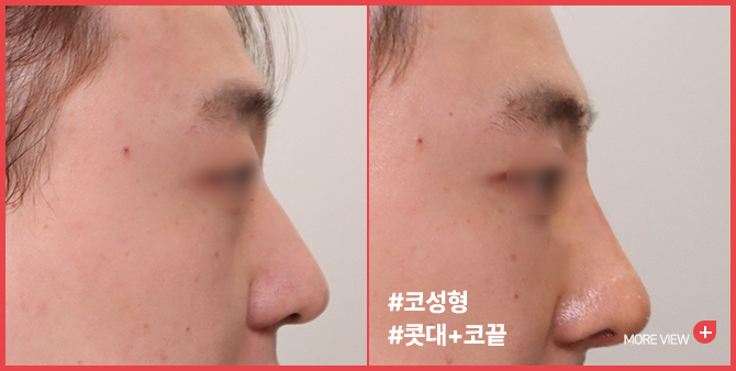 엣지 성형외과&피부과 코성형 BEFORE / AFTER