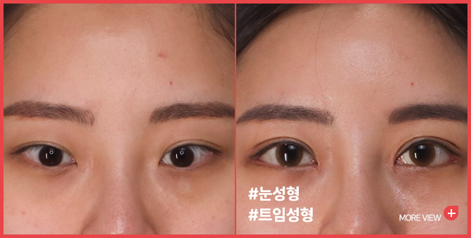 엣지 성형외과&피부과 듀얼트임 BEFORE / AFTER