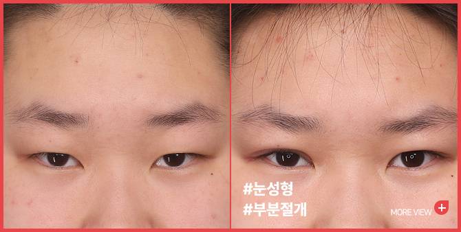 엣지 성형외과&피부과 눈성형 BEFORE / AFTER