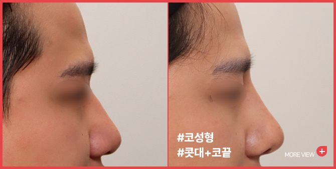 엣지 성형외과&피부과 코 성형 BEFORE / AFTER