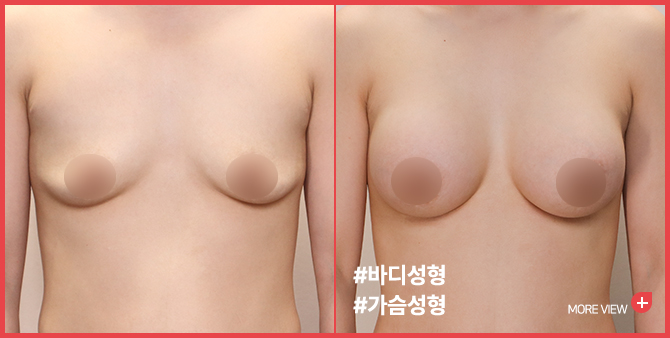 엣지 성형외과&피부과 가슴성형 BEFORE / AFTER