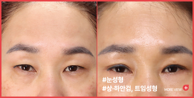 엣지 성형외과&피부과 눈 성형 BEFORE / AFTER