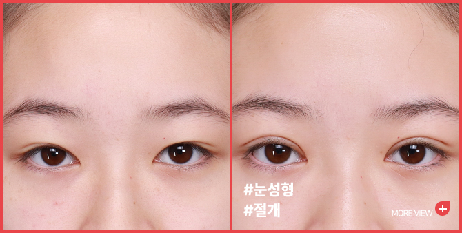 엣지 성형외과&피부과 눈성형 BEFORE / AFTER