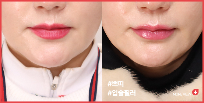 엣지 성형외과&피부과 입꼬리필러 BEFORE / AFTER