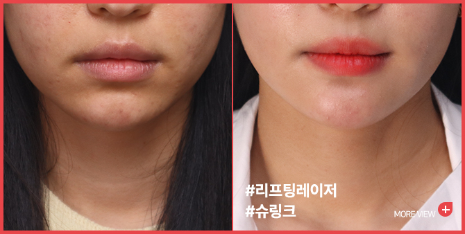 엣지 성형외과&피부과 슈링크 BEFORE / AFTER