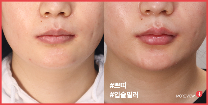 엣지 성형외과&피부과 입술필러 BEFORE / AFTER