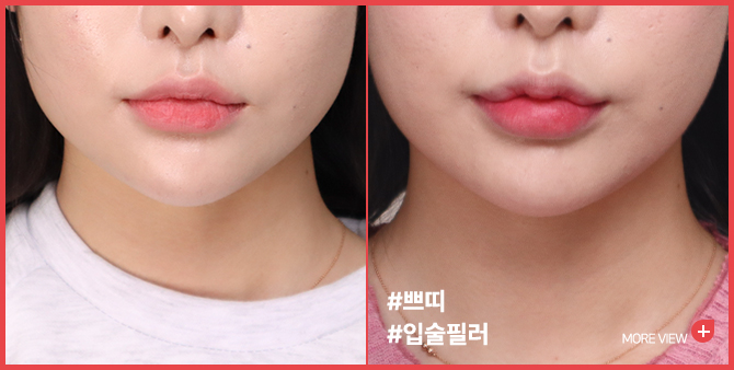 엣지 성형외과&피부과 입술필러 BEFORE / AFTER