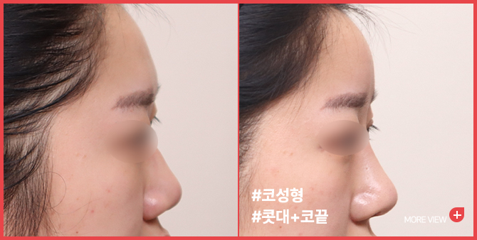 엣지 성형외과&피부과 코성형 BEFORE / AFTER