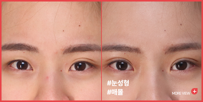 엣지 성형외과&피부과 쌍꺼풀 BEFORE / AFTER