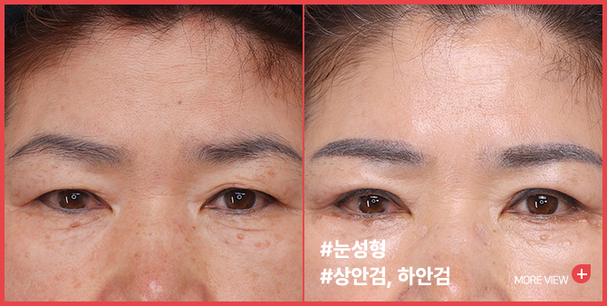 엣지 성형외과&피부과 눈성형 BEFORE / AFTER