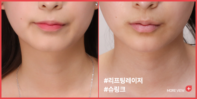 엣지 성형외과&피부과 리프팅 BEFORE / AFTER