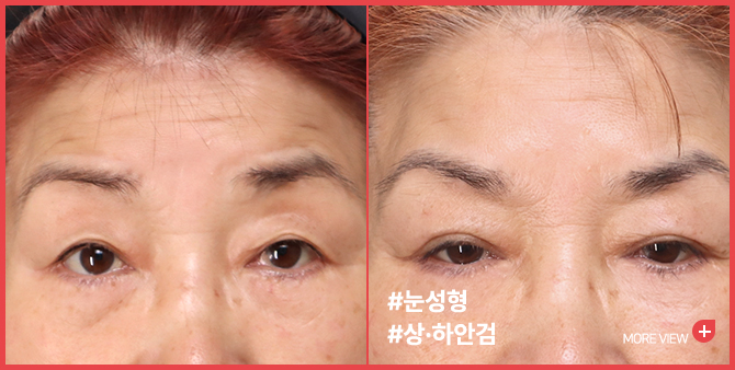 엣지 성형외과&피부과 상안검·하안검 BEFORE / AFTER