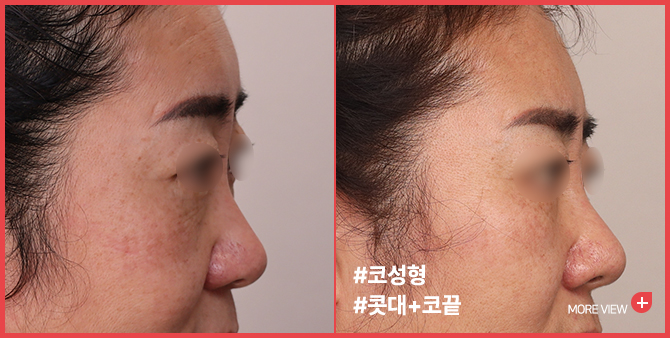 엣지 성형외과&피부과 코성형 BEFORE / AFTER