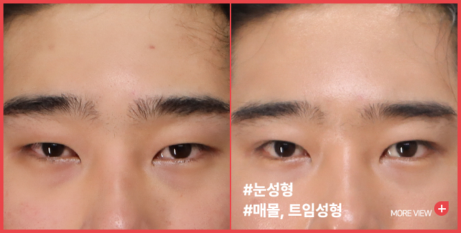 엣지 성형외과&피부과 눈 성형 BEFORE / AFTER