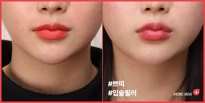 엣지 성형외과&피부과 입술필러 BEFORE / AFTER