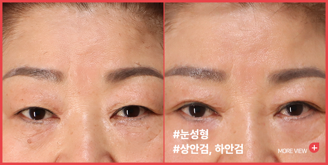 엣지 성형외과&피부과 눈성형 BEFORE / AFTER