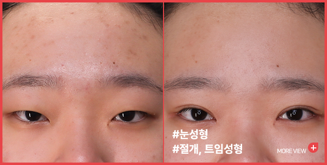 엣지성형외과&피부과_눈성형 BEFORE/AFTER