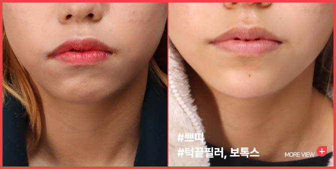 엣지 성형외과&피부과 턱끝 필러 BEFORE / AFTER