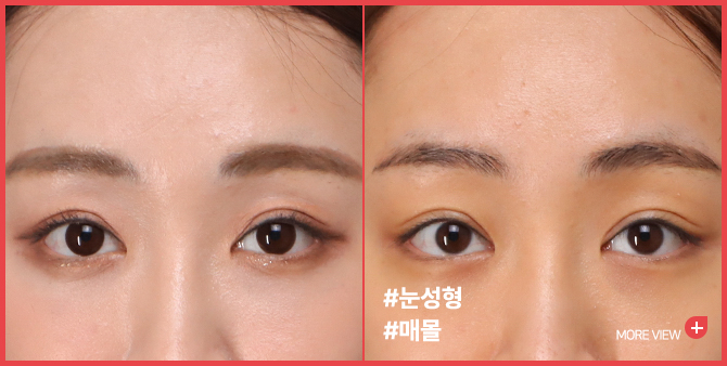 엣지 성형외과&피부과 눈 성형 BEFORE / AFTER