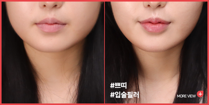 엣지 성형외과&피부과 입술필러 BEFORE / AFTER