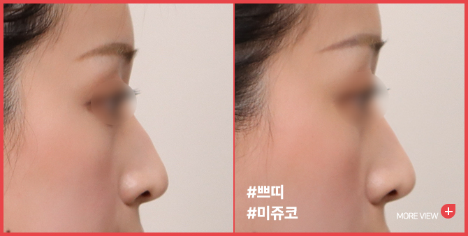 엣지 성형외과&피부과 미쥬코 BEFORE / AFTER