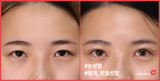 엣지성형외과&피부과_눈성형 BEFORE/AFTER
