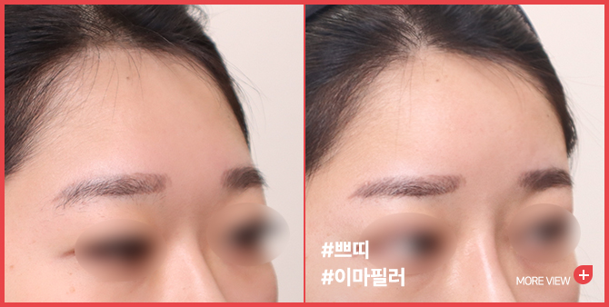엣지 성형외과&피부과 이마필러 BEFORE / AFTER