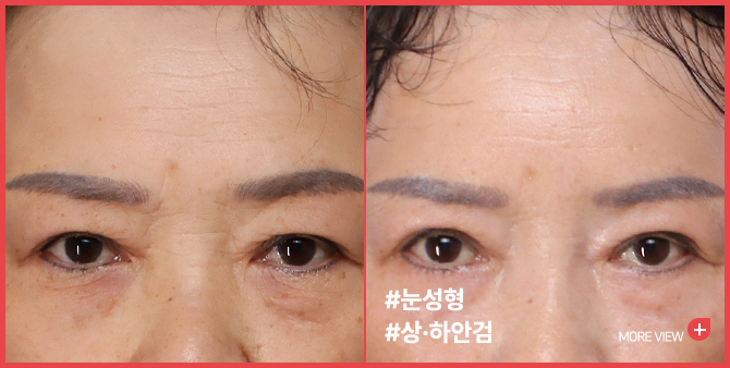 엣지 성형외과&피부과 눈 성형 BEFORE / AFTER