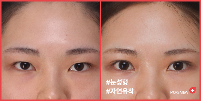 엣지 성형외과&피부과 눈성형 BEFORE / AFTER