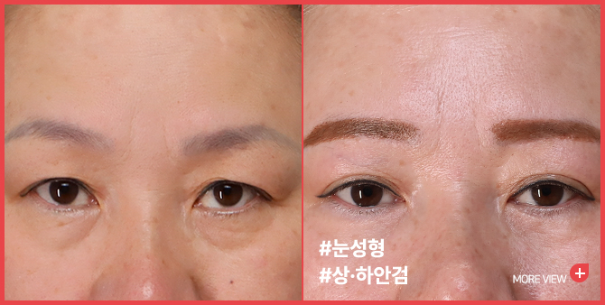 엣지 성형외과&피부과 눈 성형 BEFORE / AFTER