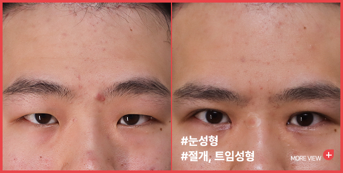 엣지성형외과&피부과_눈성형 BEFORE/AFTER