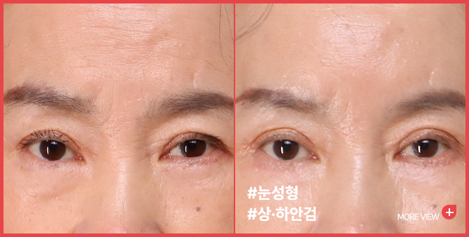 엣지 성형외과&피부과 눈 성형 BEFORE / AFTER