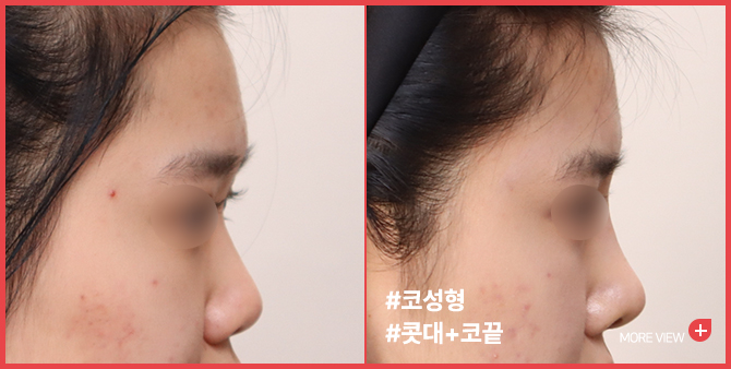 엣지 성형외과&피부과 코 성형 BEFORE / AFTER