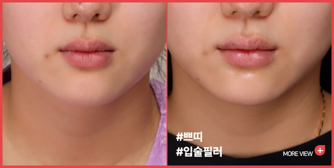 엣지 성형외과&피부과 입술필러 BEFORE / AFTER