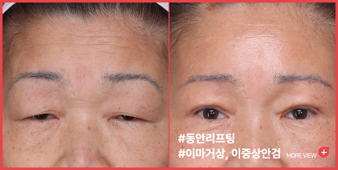 엣지 성형외과&피부과 이마거상 BEFORE / AFTER