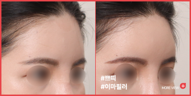 엣지 성형외과&피부과 이마필러 BEFORE / AFTER