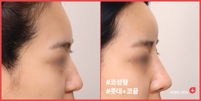 엣지 성형외과&피부과 코 성형 BEFORE / AFTER