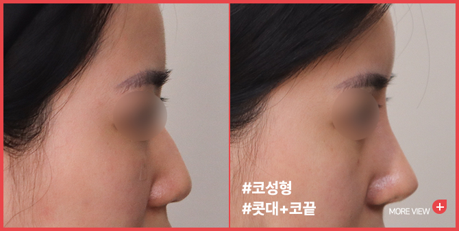 엣지 성형외과&피부과 코성형 BEFORE / AFTER