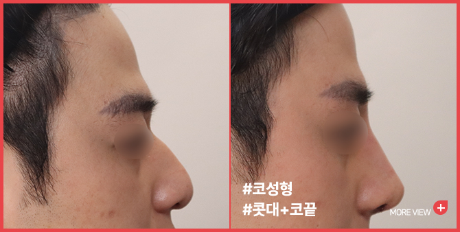 엣지 성형외과&피부과 코 성형 BEFORE / AFTER