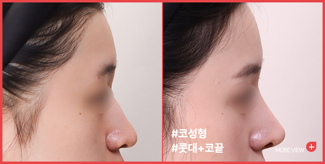 엣지 성형외과&피부과 코 성형 BEFORE / AFTER