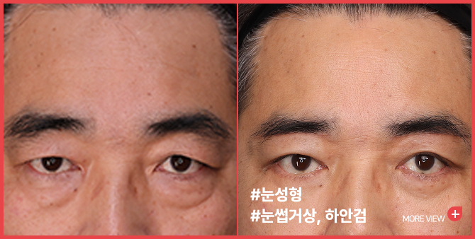 엣지 성형외과&피부과 눈성형 BEFORE / AFTER