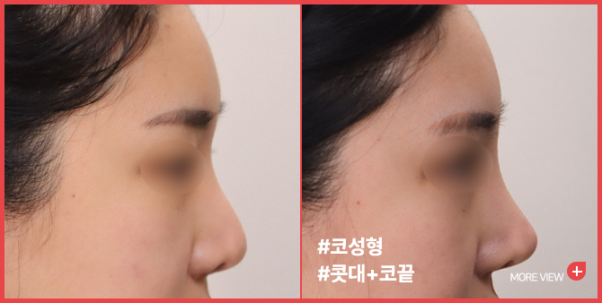 엣지 성형외과&피부과 코 성형 BEFORE / AFTER