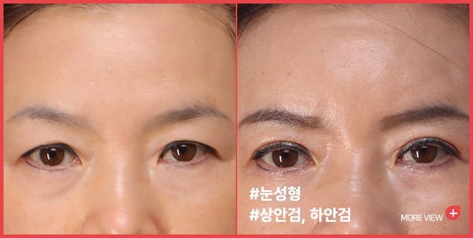 엣지 성형외과&피부과 눈성형 BEFORE / AFTER