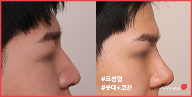 엣지 성형외과&피부과 코성형 BEFORE / AFTER